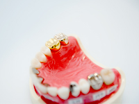 銀歯も白い歯に変えることができます